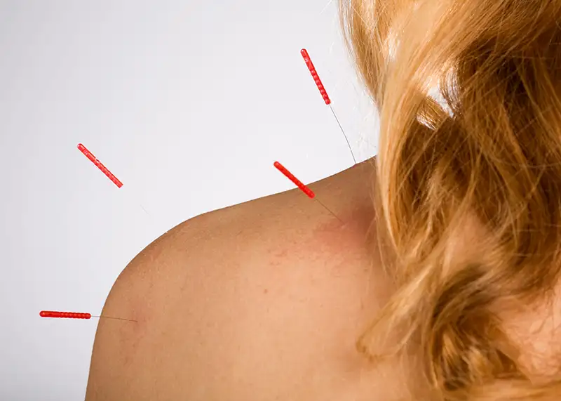 Better Together Acupuncture and Wellness Acupuncture Needles